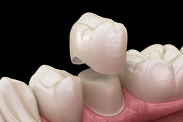 dental crowns 