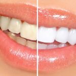 teeth whitening