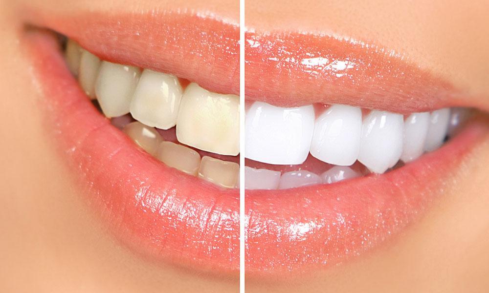 How To Keep A Long-Lasting White Smile in Fort Myers